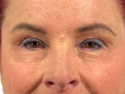 BOTOX Before & After Gallery - Patient 635661 - Image 2