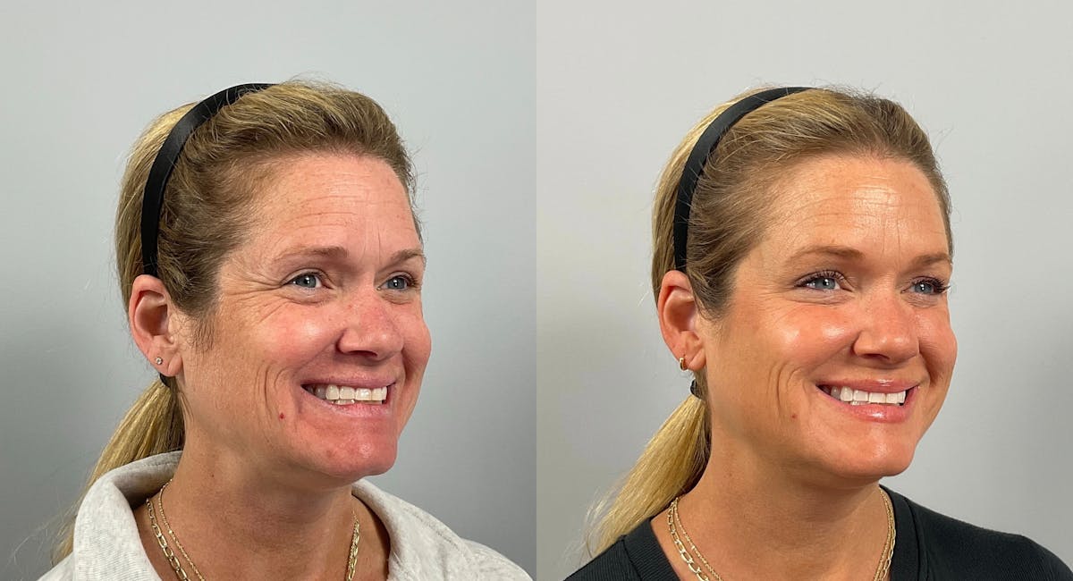 BOTOX Before & After Gallery - Patient 292466 - Image 1