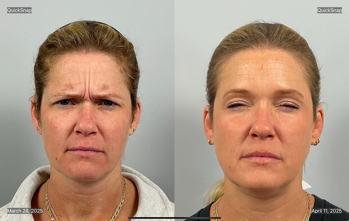 BOTOX Before & After Gallery - Patient 345847 - Image 1