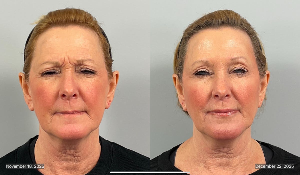BOTOX Before & After Gallery - Patient 412718 - Image 1