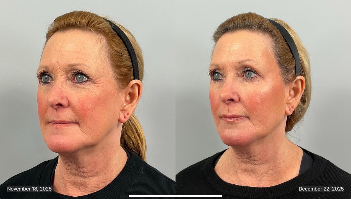 BOTOX Before & After Gallery - Patient 412718 - Image 2
