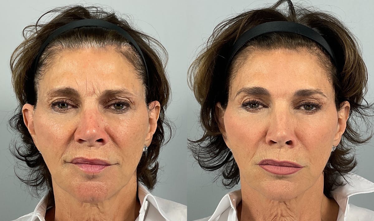 BOTOX Before & After Gallery - Patient 106993 - Image 1