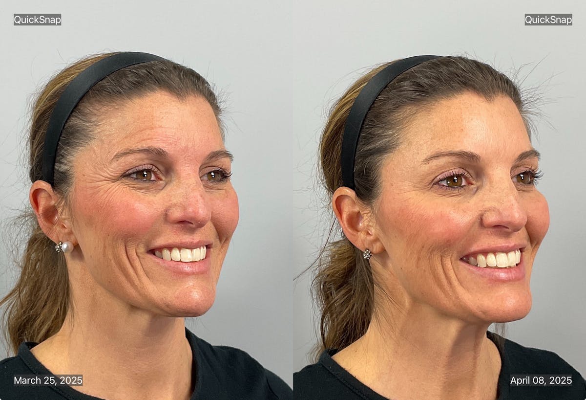 BOTOX Before & After Gallery - Patient 171923 - Image 1