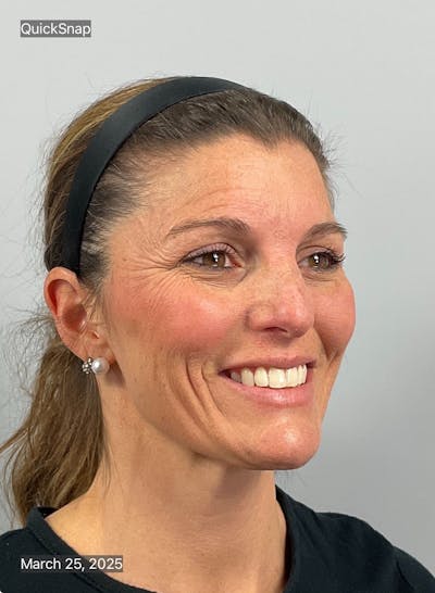 BOTOX Before & After Gallery - Patient 171923 - Image 1