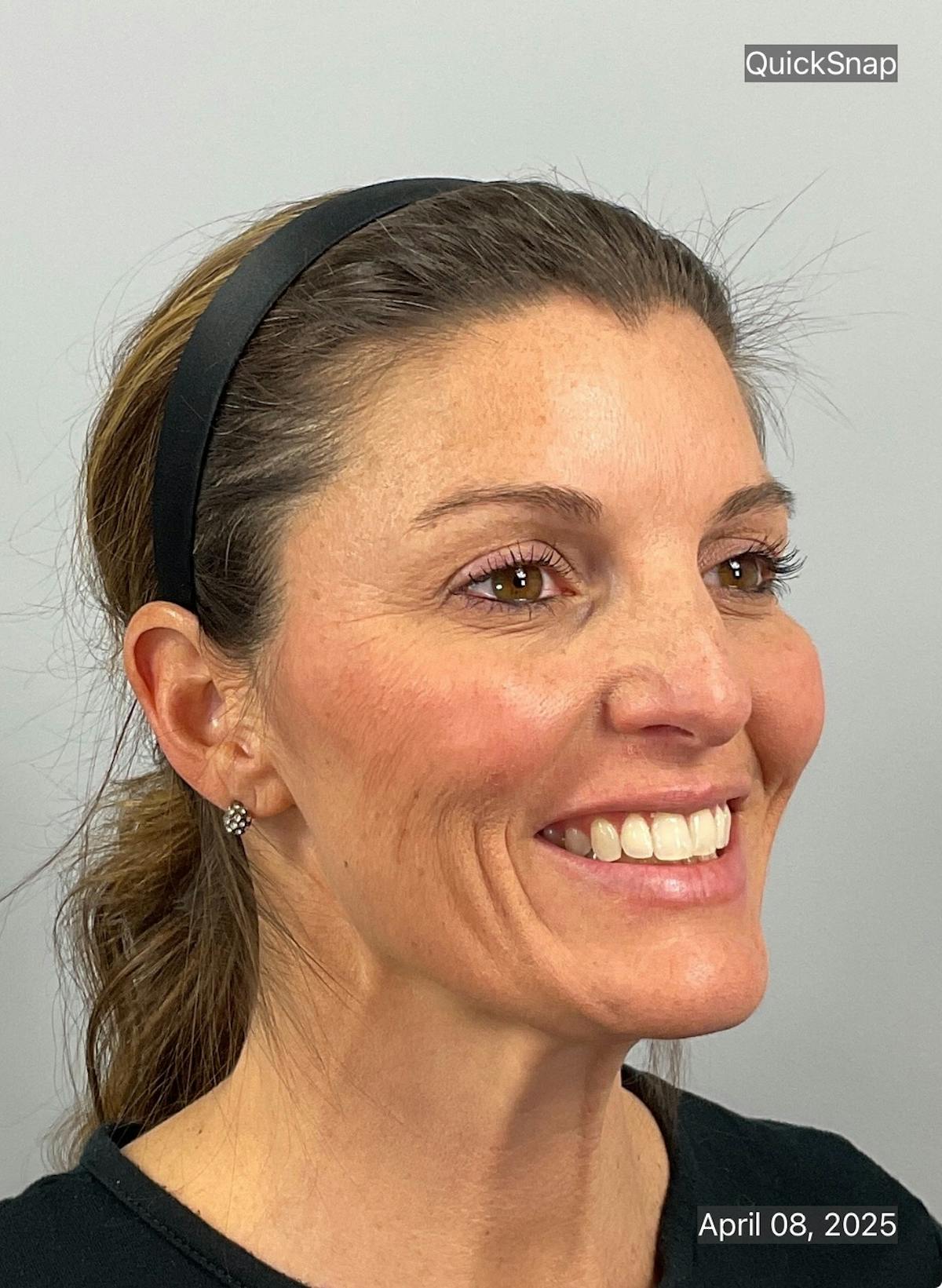 BOTOX Before & After Gallery - Patient 171923 - Image 2