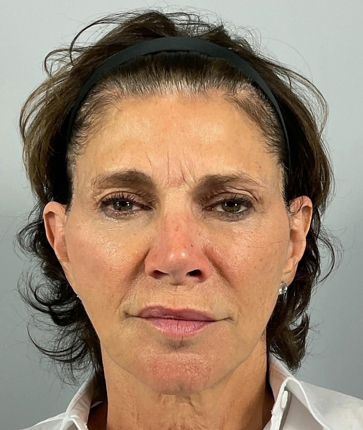 BOTOX Before & After Gallery - Patient 106993 - Image 1
