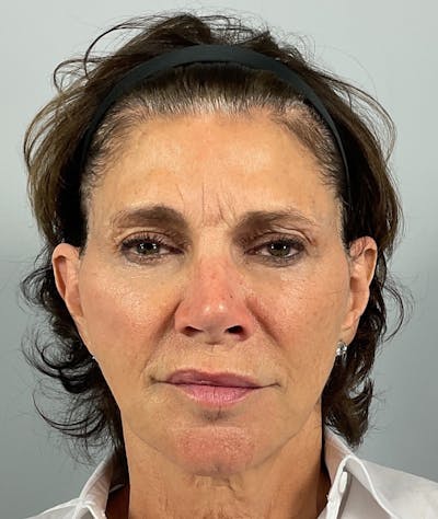 BOTOX Before & After Gallery - Patient 106993 - Image 1