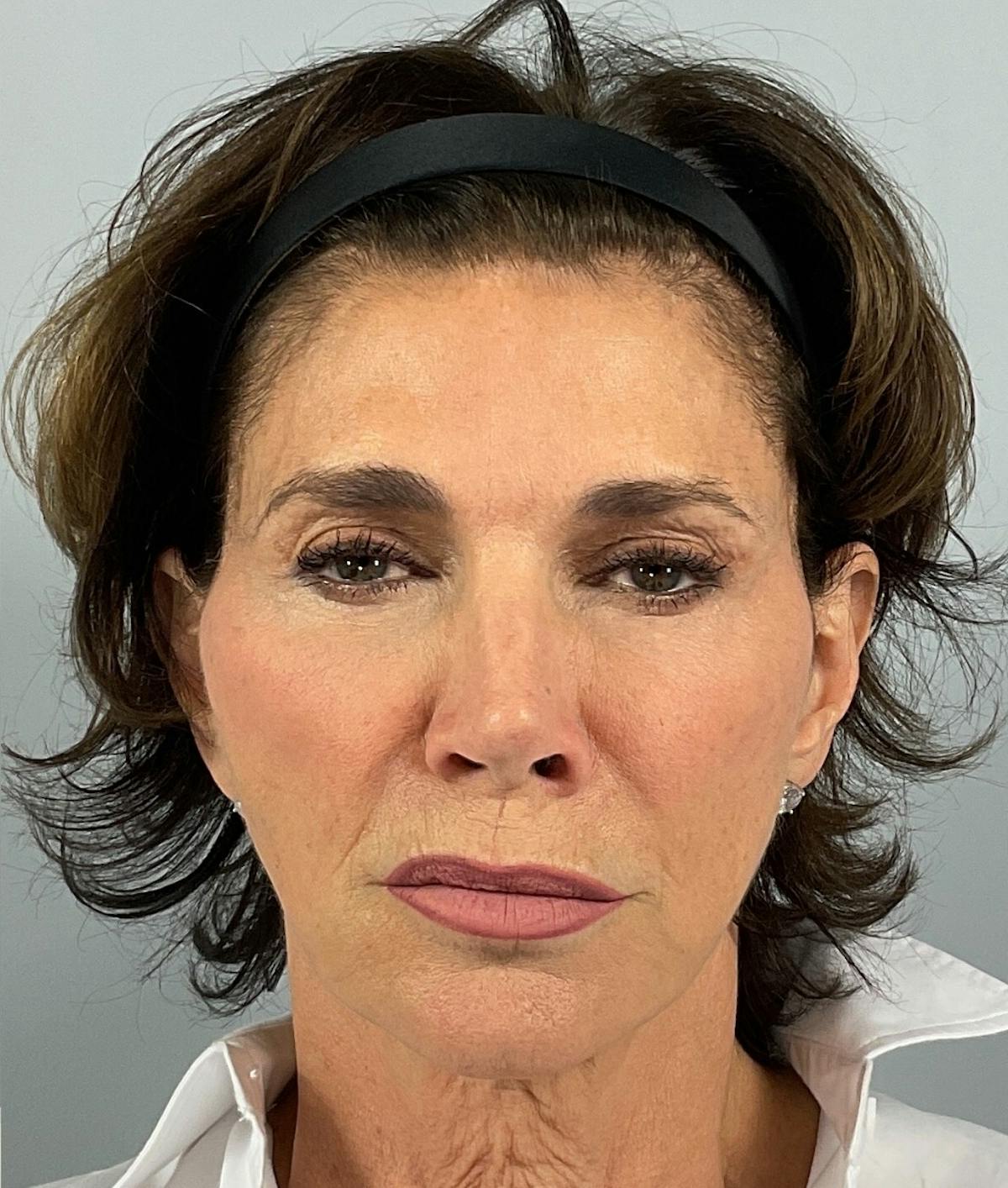 BOTOX Before & After Gallery - Patient 106993 - Image 2