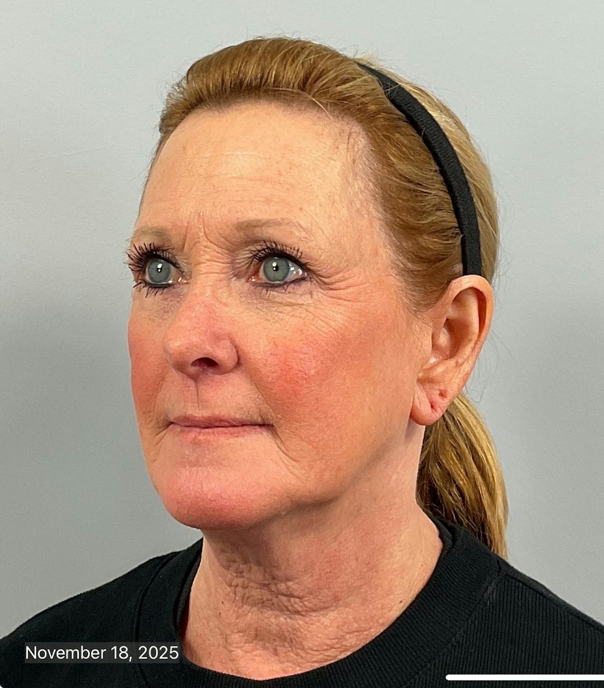 BOTOX Before & After Gallery - Patient 412718 - Image 3