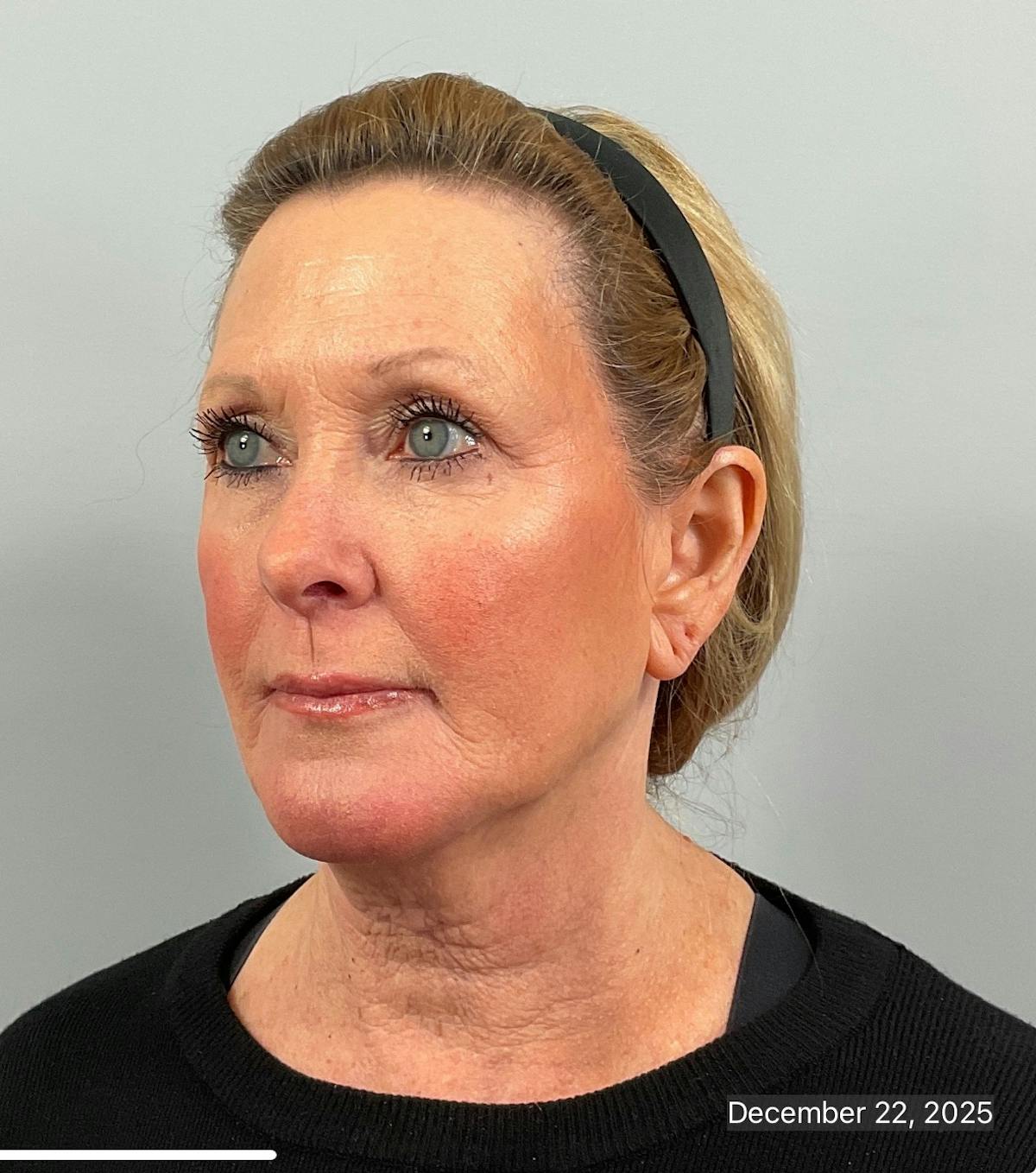BOTOX Before & After Gallery - Patient 412718 - Image 4
