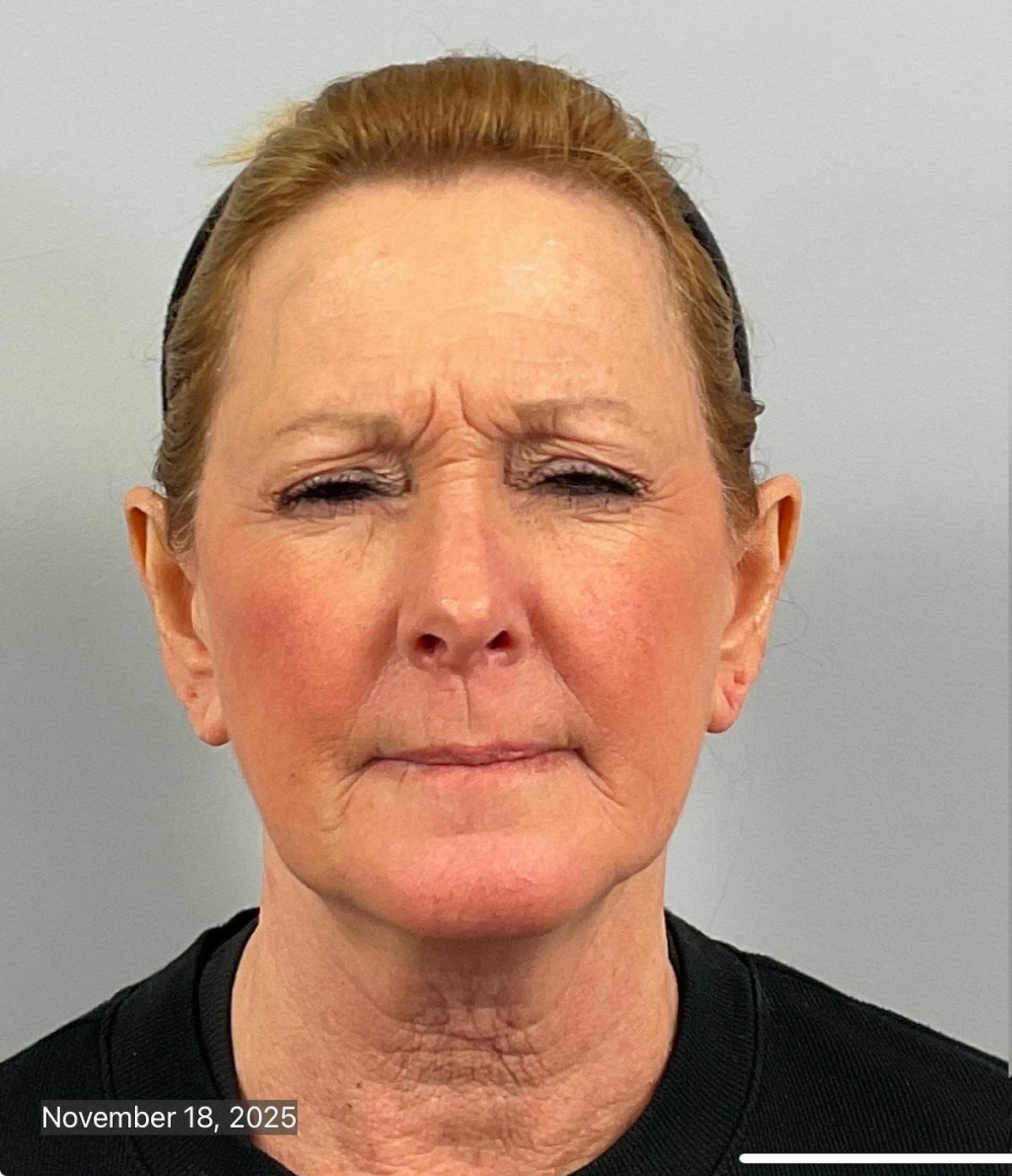 BOTOX Before & After Gallery - Patient 412718 - Image 1