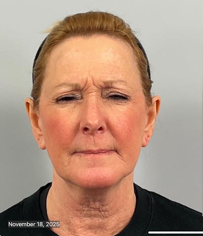 BOTOX Before & After Gallery - Patient 412718 - Image 1