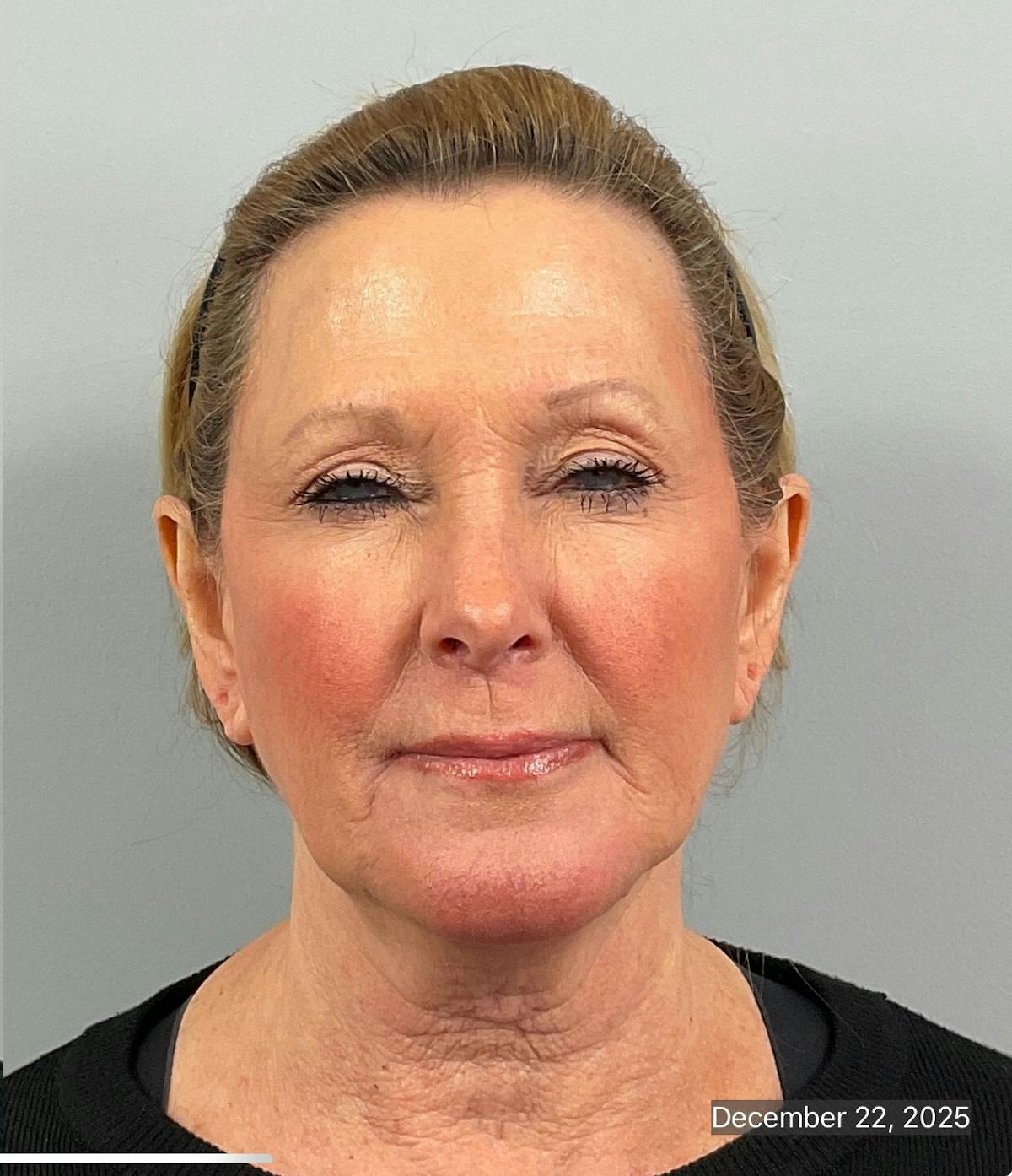BOTOX Before & After Gallery - Patient 412718 - Image 2