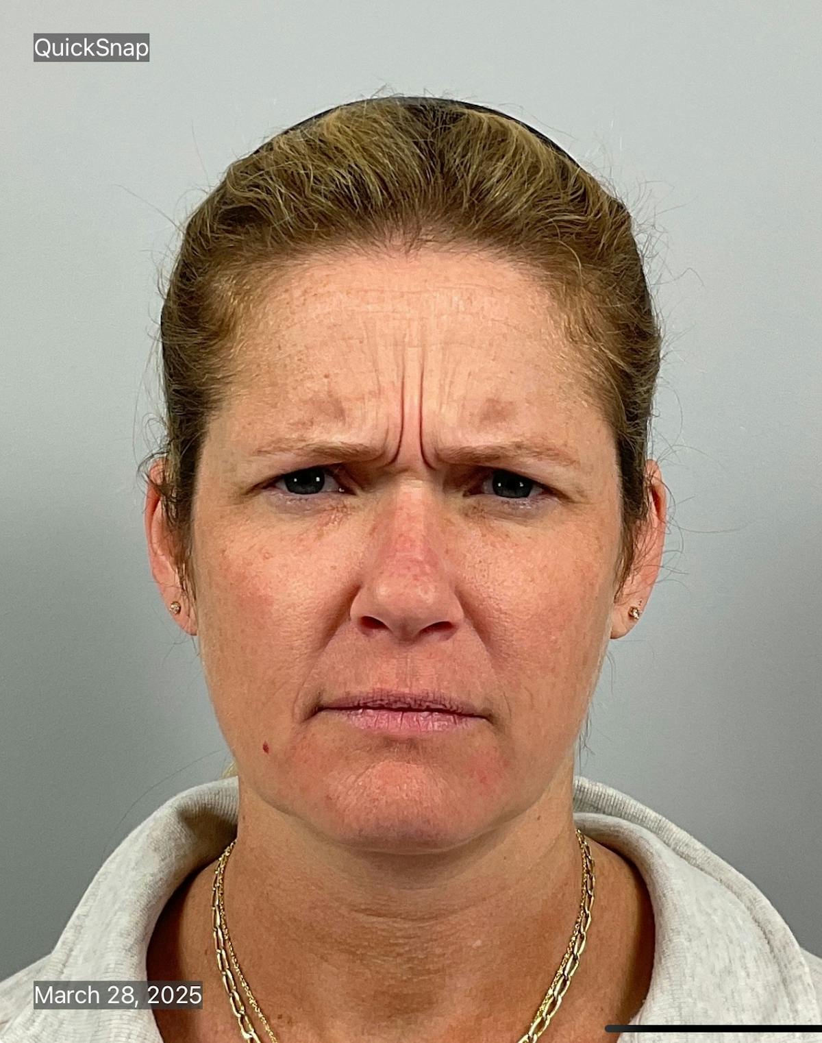 BOTOX Before & After Gallery - Patient 345847 - Image 1