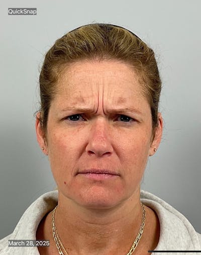 BOTOX Before & After Gallery - Patient 345847 - Image 1