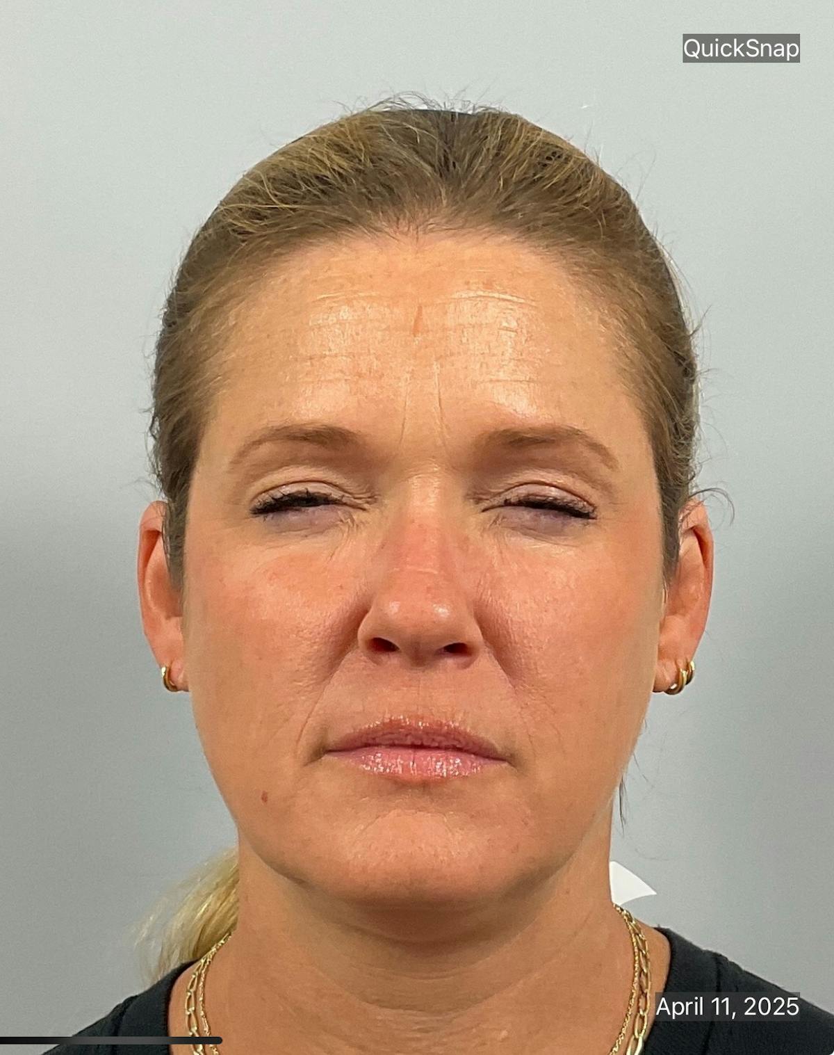 BOTOX Before & After Gallery - Patient 345847 - Image 2