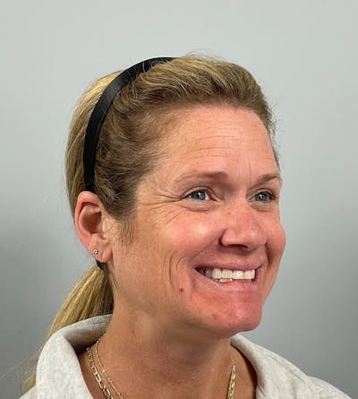 BOTOX Before & After Gallery - Patient 292466 - Image 1