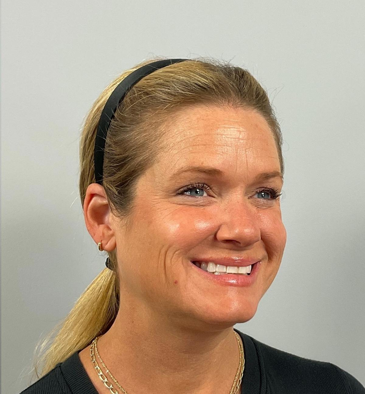 BOTOX Before & After Gallery - Patient 292466 - Image 2