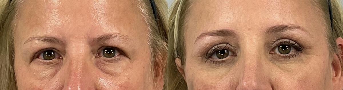 Eyelid Lift/Blepharoplasty Before & After Gallery - Patient 301917 - Image 1