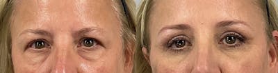 Eyelid Lift/Blepharoplasty Before & After Gallery - Patient 301917 - Image 1