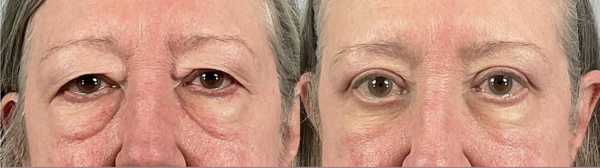 Eyelid Lift/Blepharoplasty Before & After Gallery - Patient 384253 - Image 1