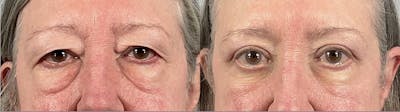 Eyelid Lift/Blepharoplasty Before & After Gallery - Patient 384253 - Image 1