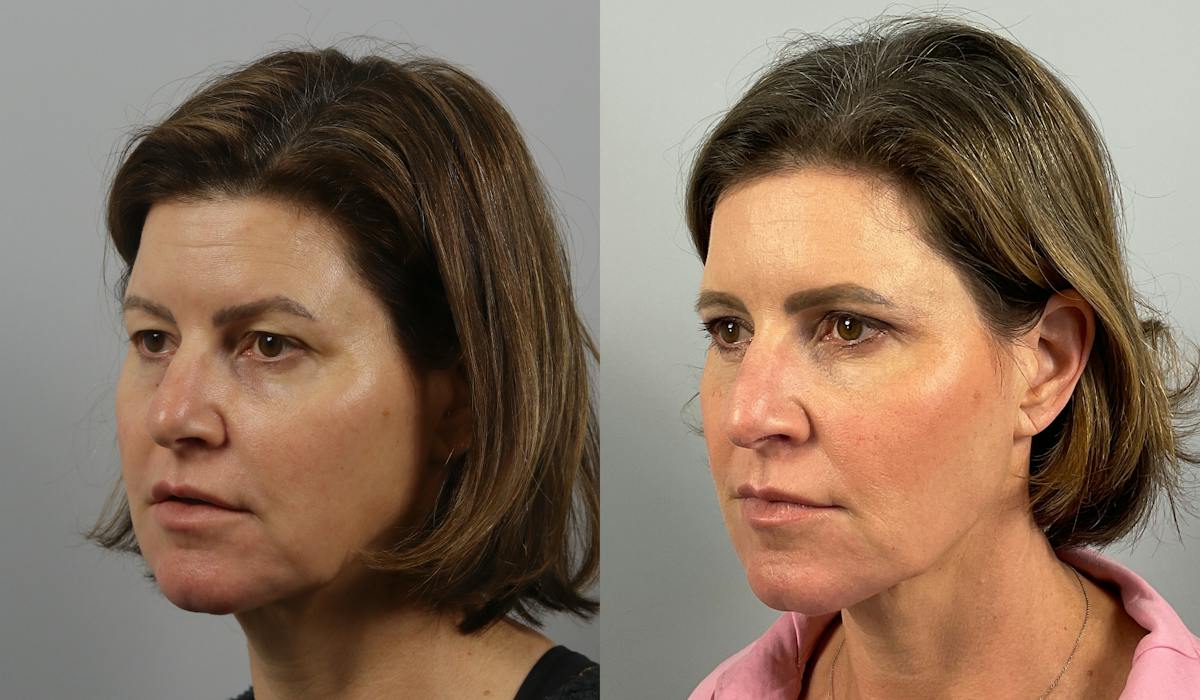 Eyelid Lift/Blepharoplasty Before & After Gallery - Patient 339810 - Image 2