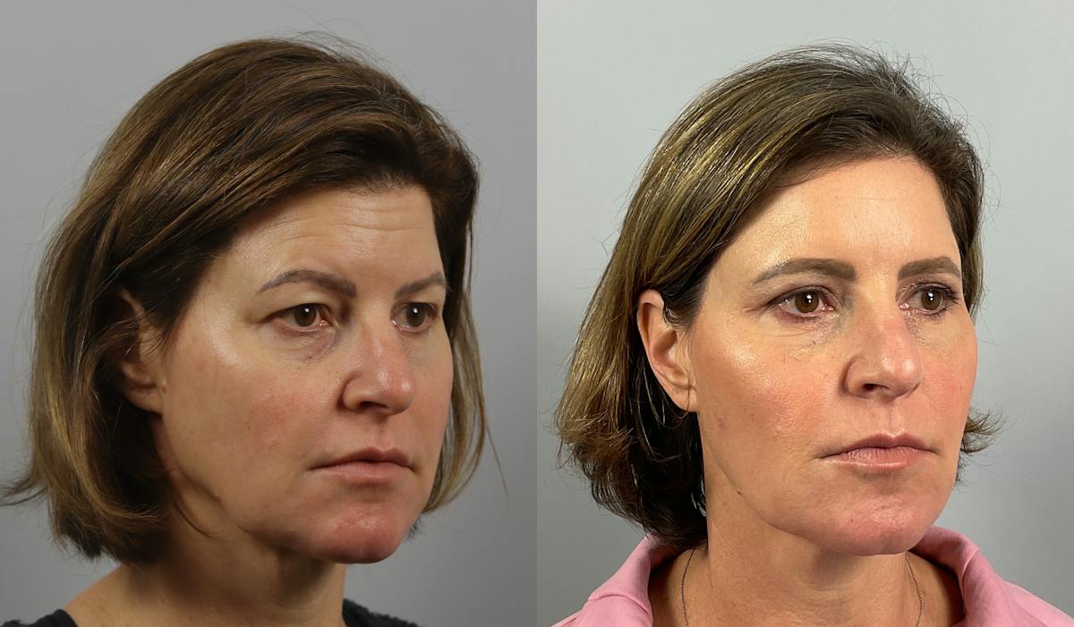 Eyelid Lift/Blepharoplasty Before & After Gallery - Patient 339810 - Image 1