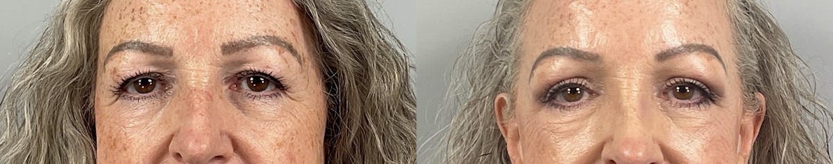 Eyelid Lift/Blepharoplasty Before & After Gallery - Patient 410783 - Image 4