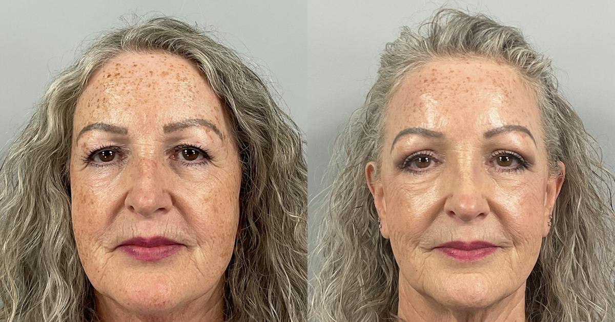 Eyelid Lift/Blepharoplasty Before & After Gallery - Patient 410783 - Image 1