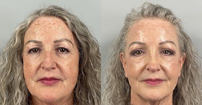 Eyelid Lift/Blepharoplasty Before & After Gallery - Patient 410783 - Image 1
