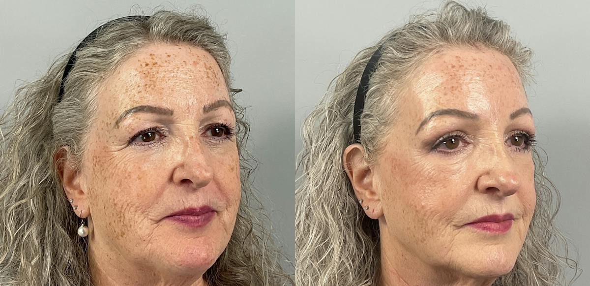 Eyelid Lift/Blepharoplasty Before & After Gallery - Patient 410783 - Image 2