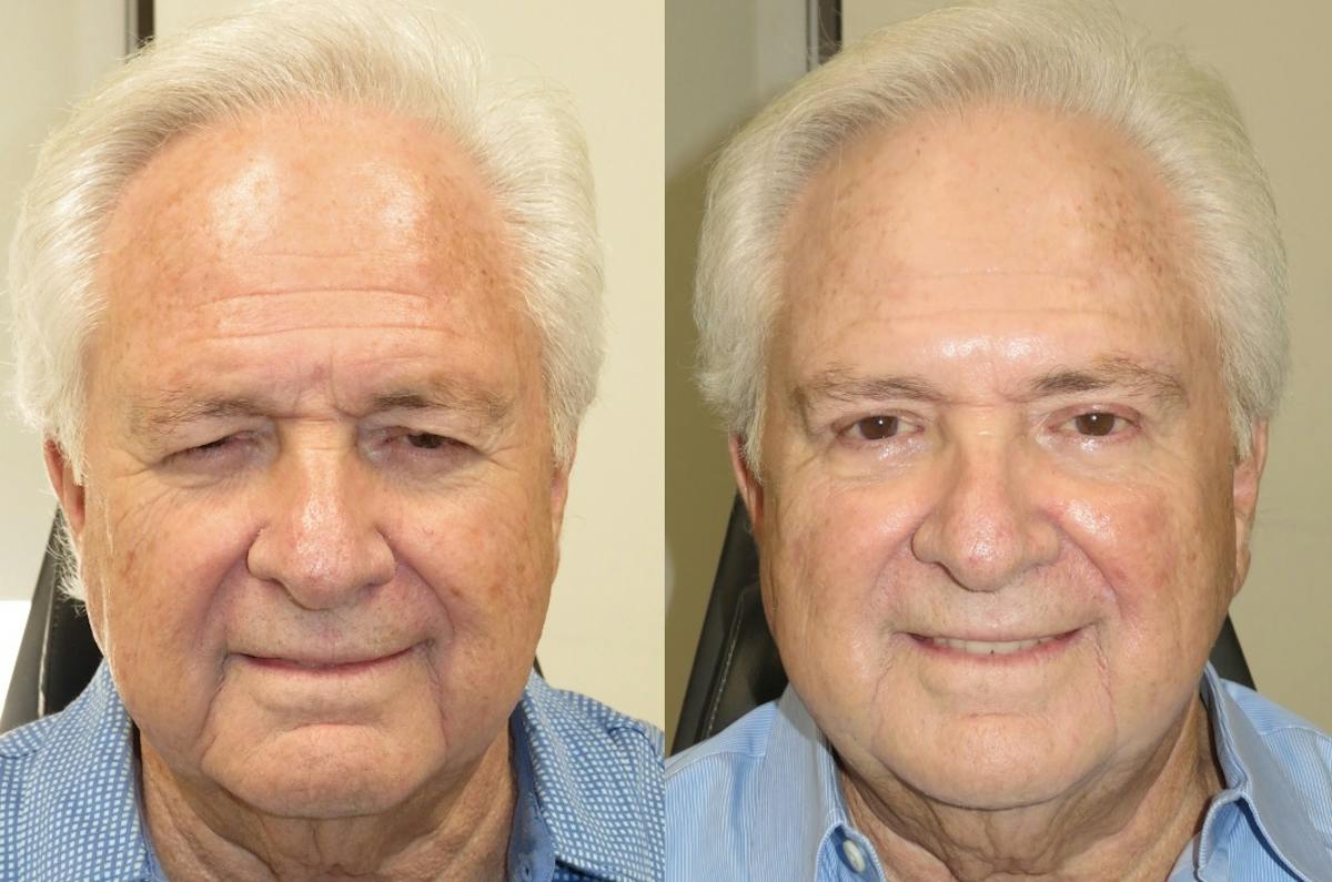 Eyelid Lift/Blepharoplasty Before & After Gallery - Patient 122854 - Image 1