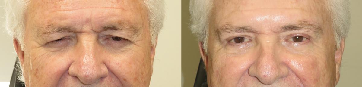 Eyelid Lift/Blepharoplasty Before & After Gallery - Patient 122854 - Image 2