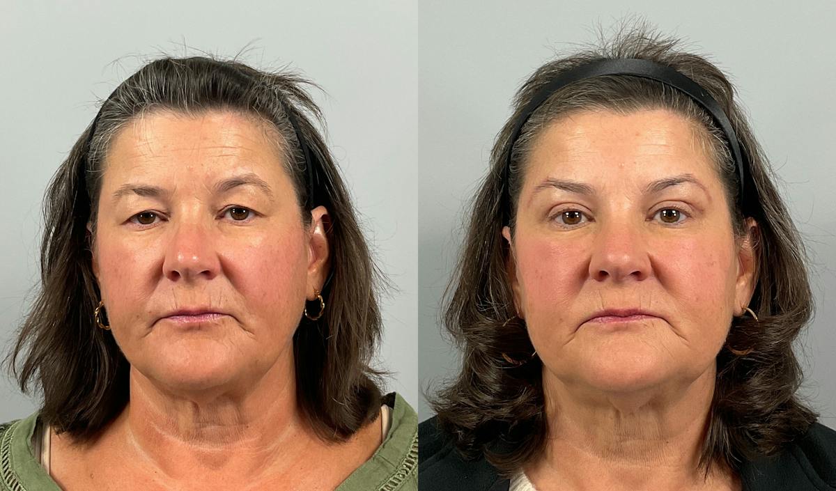 Eyelid Lift/Blepharoplasty Before & After Gallery - Patient 248890 - Image 1