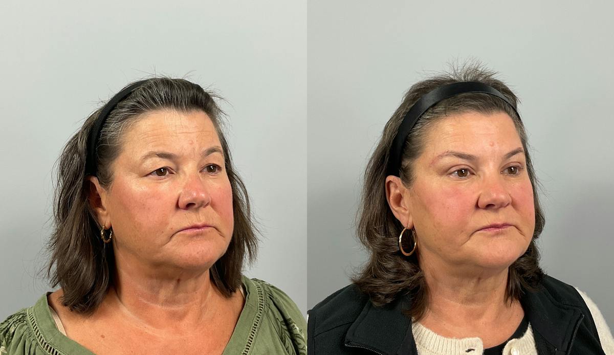Eyelid Lift/Blepharoplasty Before & After Gallery - Patient 248890 - Image 3
