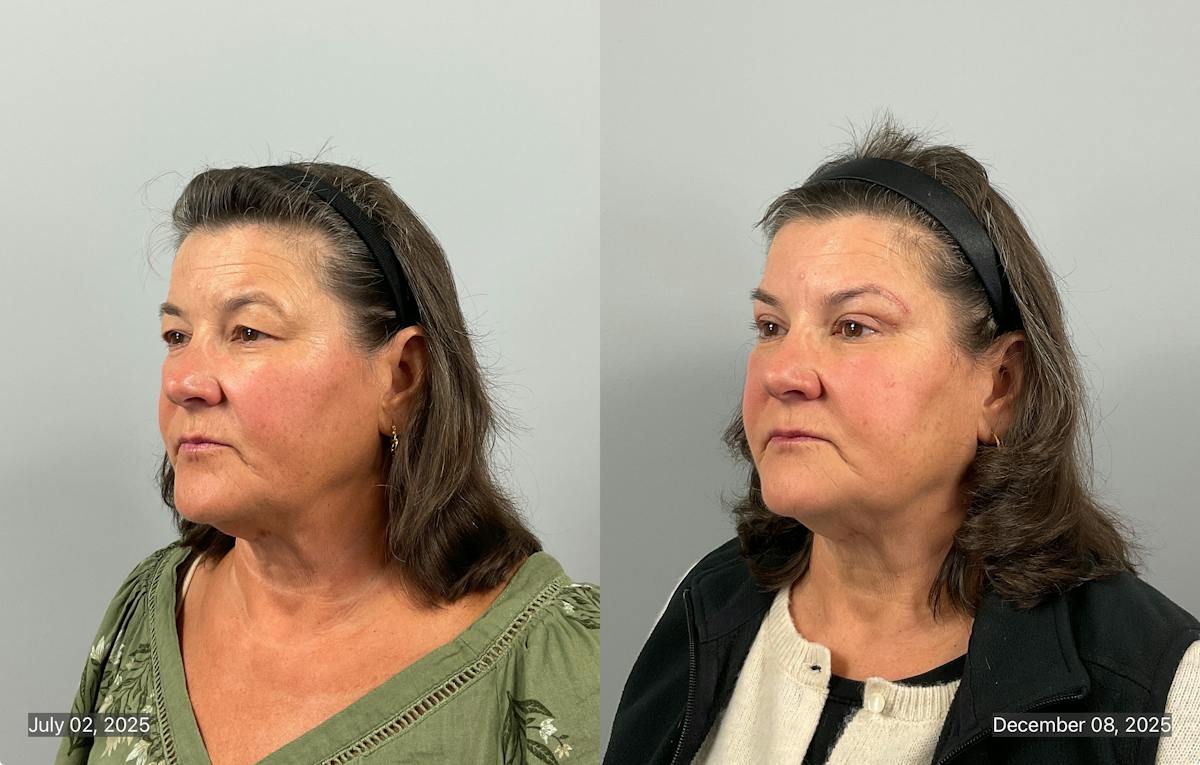 Eyelid Lift/Blepharoplasty Before & After Gallery - Patient 248890 - Image 2