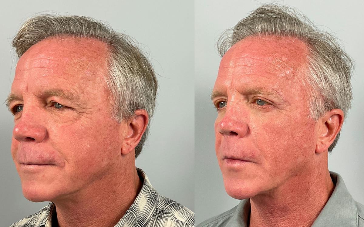 Eyelid Lift/Blepharoplasty Before & After Gallery - Patient 343852 - Image 2