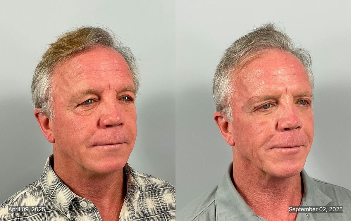 Eyelid Lift/Blepharoplasty Before & After Gallery - Patient 343852 - Image 1