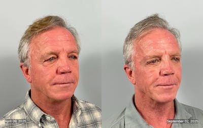 Eyelid Lift/Blepharoplasty Before & After Gallery - Patient 343852 - Image 1