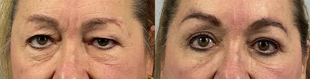 Eyelid Lift/Blepharoplasty Before & After Gallery - Patient 135520 - Image 1
