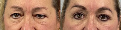 Eyelid Lift/Blepharoplasty Before & After Gallery - Patient 135520 - Image 1