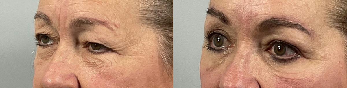 Eyelid Lift/Blepharoplasty Before & After Gallery - Patient 135520 - Image 2