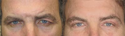 Eyelid Lift/Blepharoplasty Before & After Gallery - Patient 835370 - Image 1