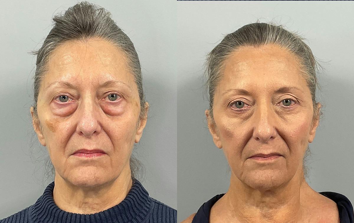 Eyelid Lift/Blepharoplasty Before & After Gallery - Patient 279179 - Image 1