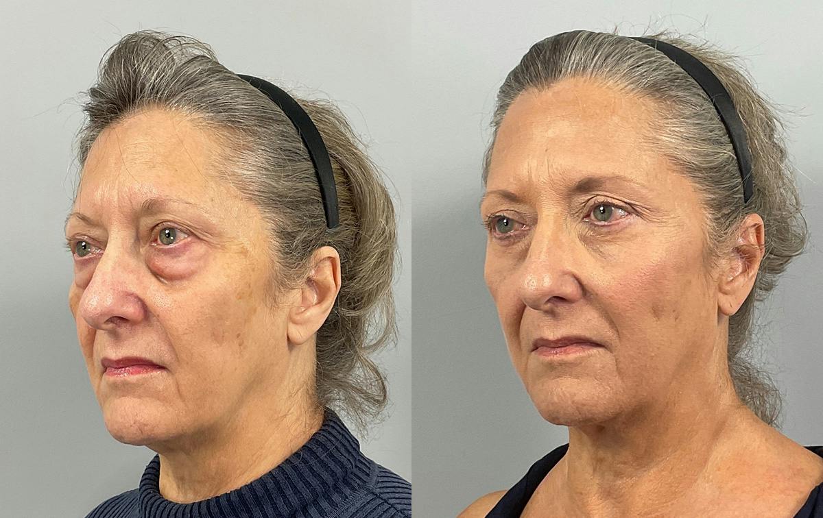 Eyelid Lift/Blepharoplasty Before & After Gallery - Patient 279179 - Image 2