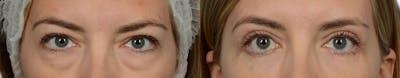 Blepharoplasty (Eyelid Surgery) Before & After Gallery - Patient 112056 - Image 1