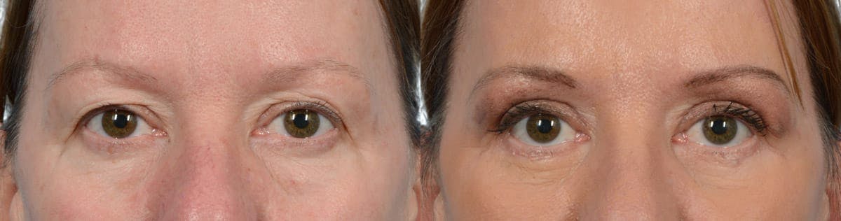 Blepharoplasty (Eyelid Surgery) Before & After Gallery - Patient 355064 - Image 1