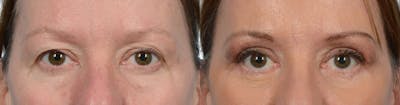Blepharoplasty (Eyelid Surgery) Before & After Gallery - Patient 355064 - Image 1