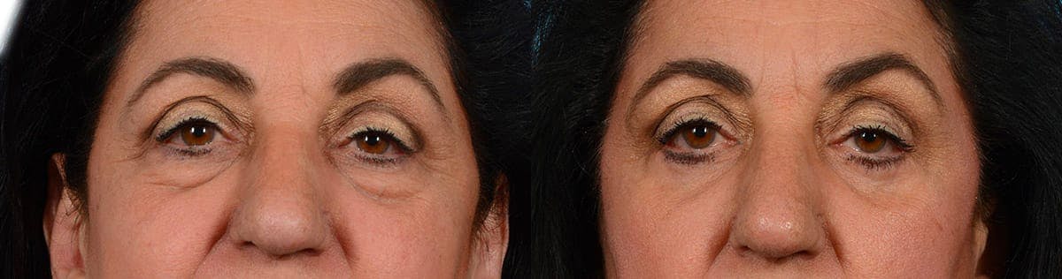 Blepharoplasty (Eyelid Surgery) Before & After Gallery - Patient 313616 - Image 1